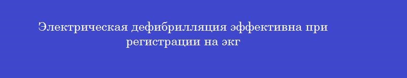 Электрическая дефибрилляция эффективна при регистрации на экг